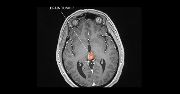 Pineal Region Tumors - National Cancer Institute