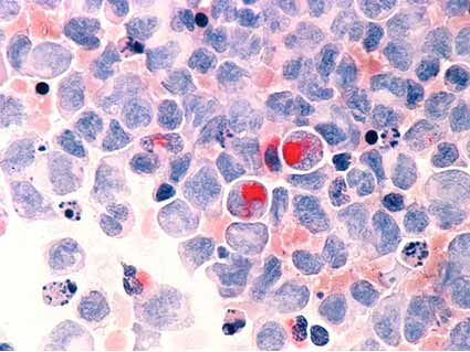 cells with acute myelocytic leukemia