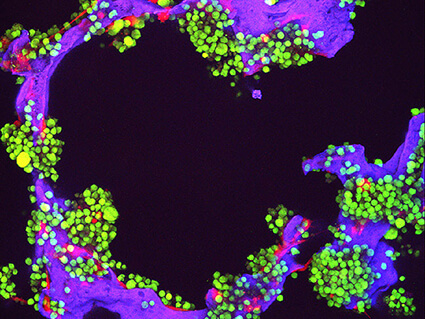Myeloma tumor cells (green) and bone cells (red) growing on a lab-made scaffold (purple).