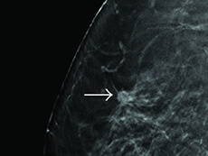 Nódulos en los senos descubiertos durante un examen de detección. 