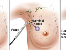 A sentinel lymph node biopsy of the skin.