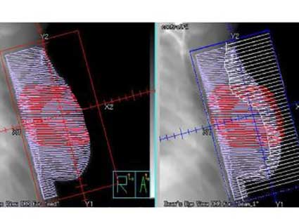 An example of partial-breast radiation therapy.