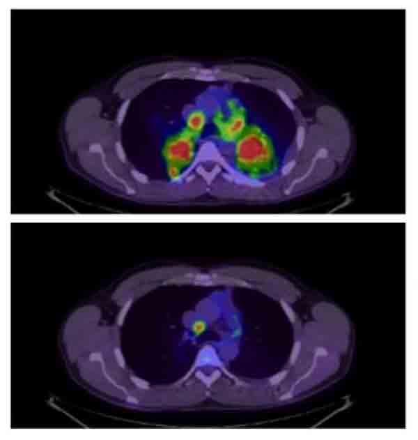 Before and after PET scan of patient treated with crizotinib.