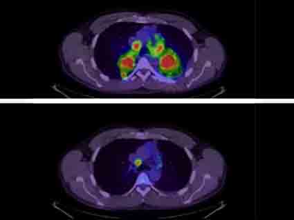 Before and after PET scan of patient treated with crizotinib.