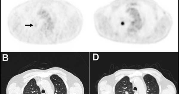 how to stage renal cell carcinoma