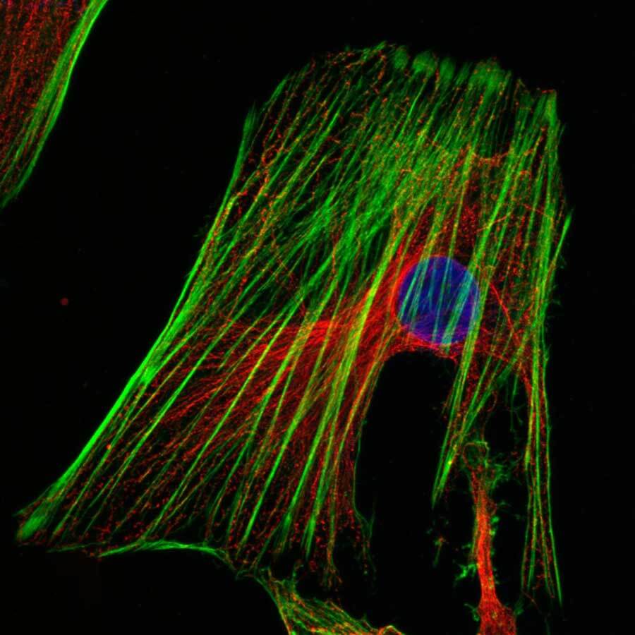 metastatic cervical cancer cells