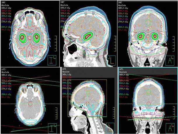 An image comparing whole brain radiation therapy that avoids the hippocampus with standard whole brain radiation therapy.
