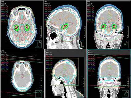 An image comparing whole brain radiation therapy that avoids the hippocampus with standard whole brain radiation therapy.