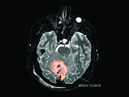 An MRI of a medulloblastoma tumor.