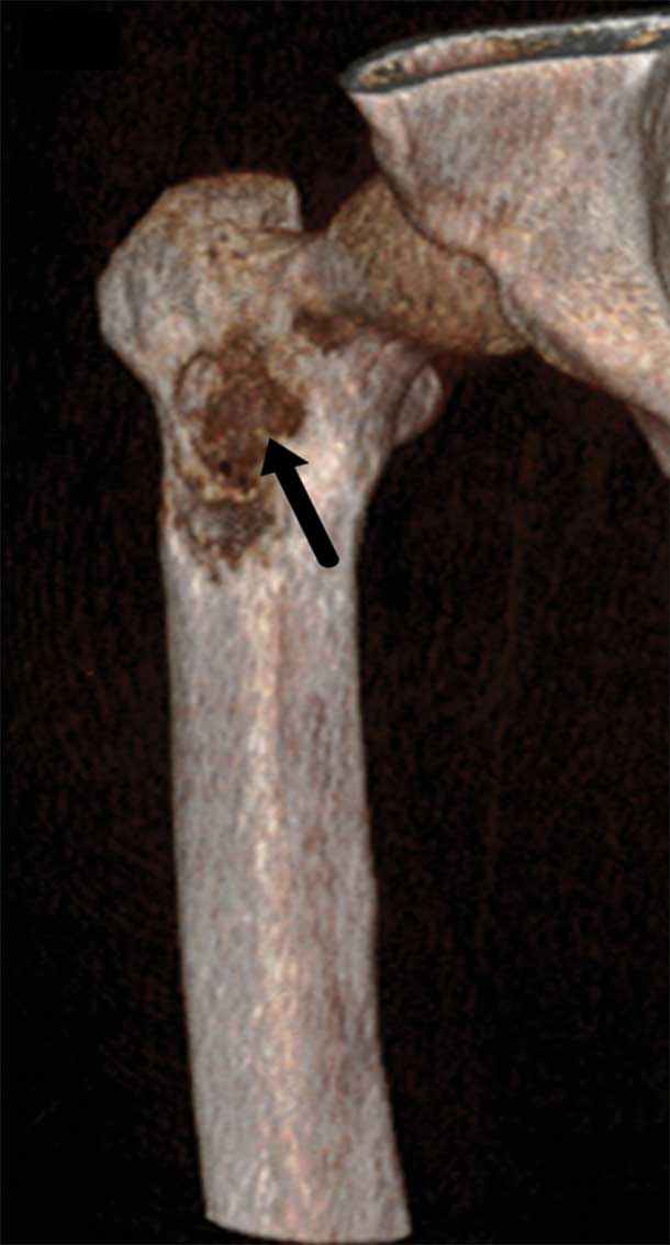 An imaging scan of an alveolar soft-part sarcoma in a femur.