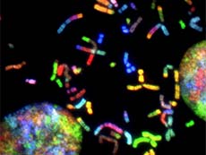 Cromosomas de células de glioblastoma. Una nueva investigación indica que hombres y mujeres responden de manera diferente a los tratamientos para el glioblastoma.