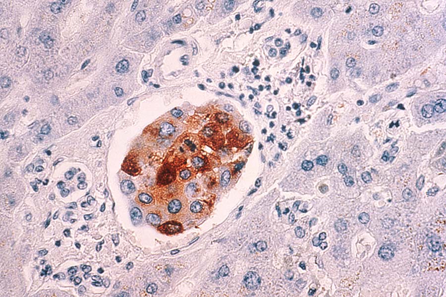 Metastatic breast cancer cells in the liver.