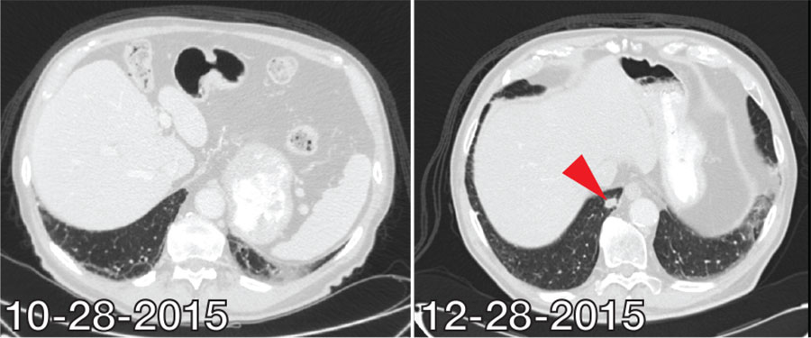A chest CT scan of a patient who developed tuberculosis.