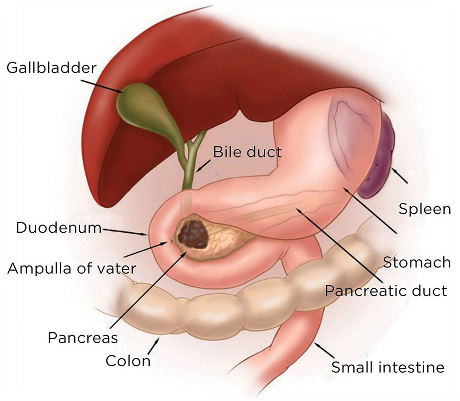 Illustration of a pancreatic tumor.