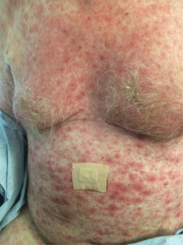 Image of a man with a severe rash across his chest and stomach.