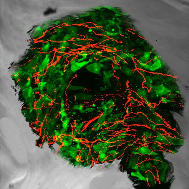 Sensory Nerve Fibers in Prostate Tumor Cells