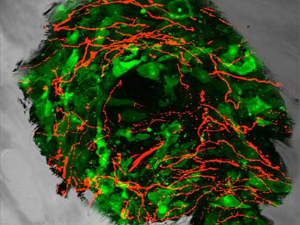 Sensory Nerve Fibers in Prostate Tumor Cells