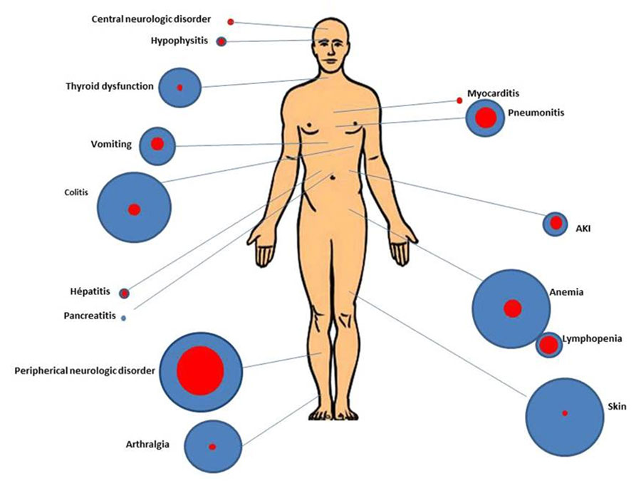 A body diagram showing locations of immunotherapy-related side effects.