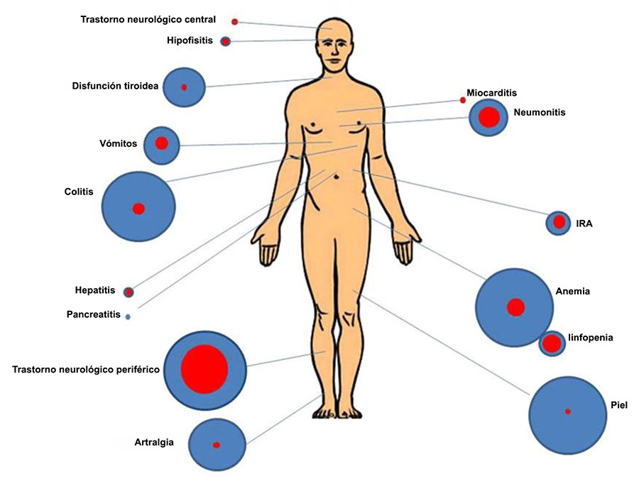 Un diagrama del cuerpo que muestra la ubicación de los efectos secundarios relacionados con la inmunoterapia.