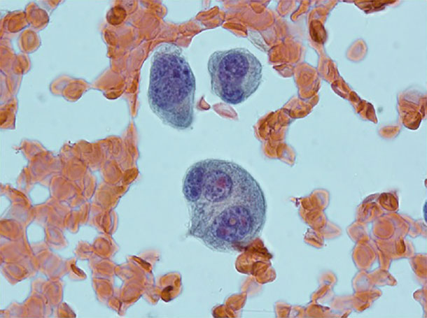 An image of abnormal plasma cells.