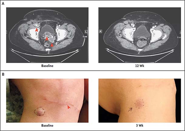 Before and after images of patient peritoneum and lymph nodes following pembrolizumab treatment.