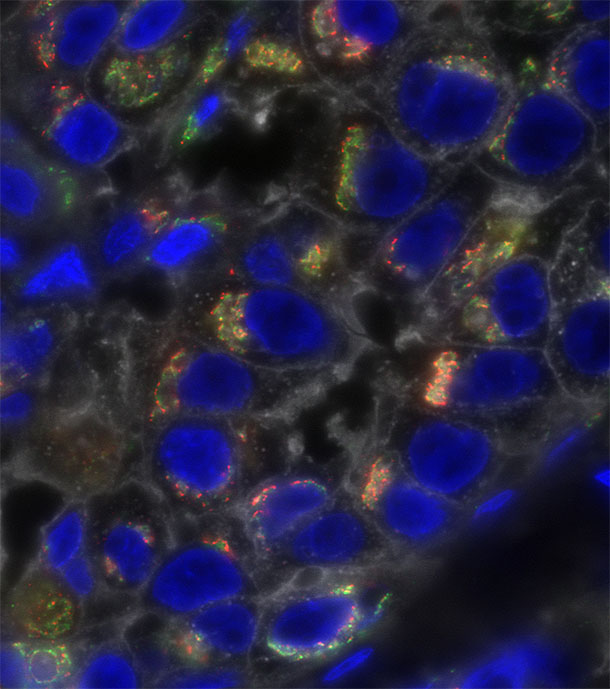 Triple-negative breast cancer cells stained to show profound molecular heterogeneity.