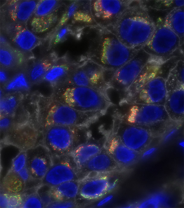 Células de cáncer triple negativo de seno se tiñeron para mostrar una heterogeneidad molecular profunda.