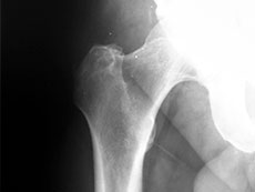 X-ray of tumor in bone