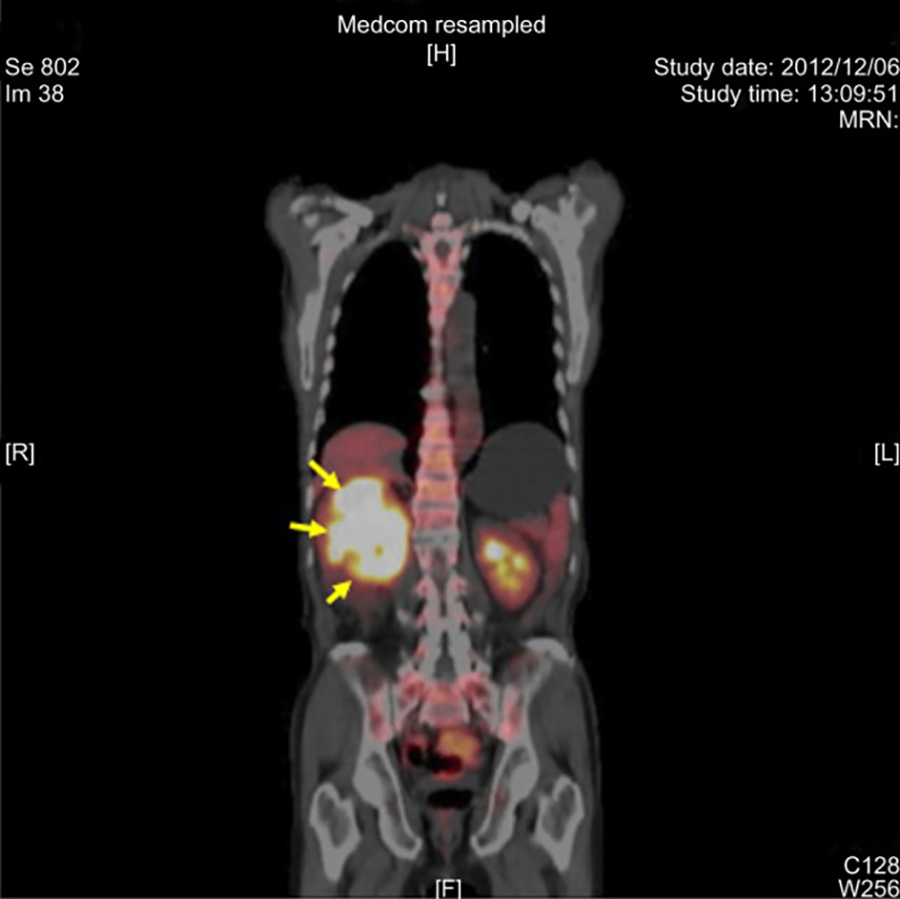PET scan of a kidney tumor
