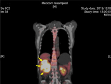Imagen de PET de un tumor en riñón derecho (flechas).