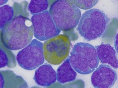 Morphology of cells from two patients with MPAL