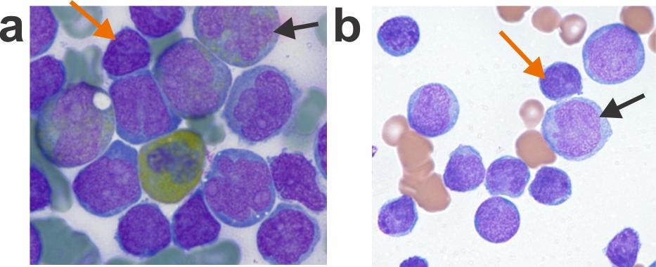 Morphology of cells from two patients with MPAL