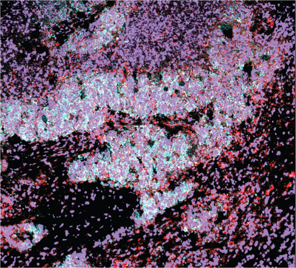 Small cell lung cancer cells with a subpopulation of cells expressing PLCG2.