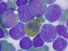 Morphology of cells from two patients with MPAL