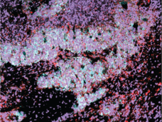 Small cell lung cancer cells with a subpopulation of cells expressing PLCG2.