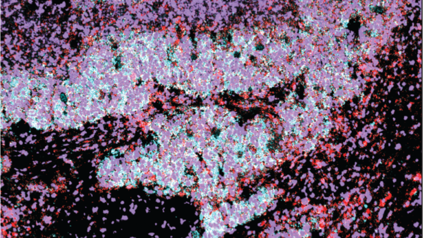 Small cell lung cancer cells with a subpopulation of cells expressing PLCG2.