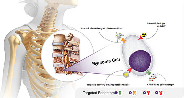 A myeloma cell within the human skeletal system.