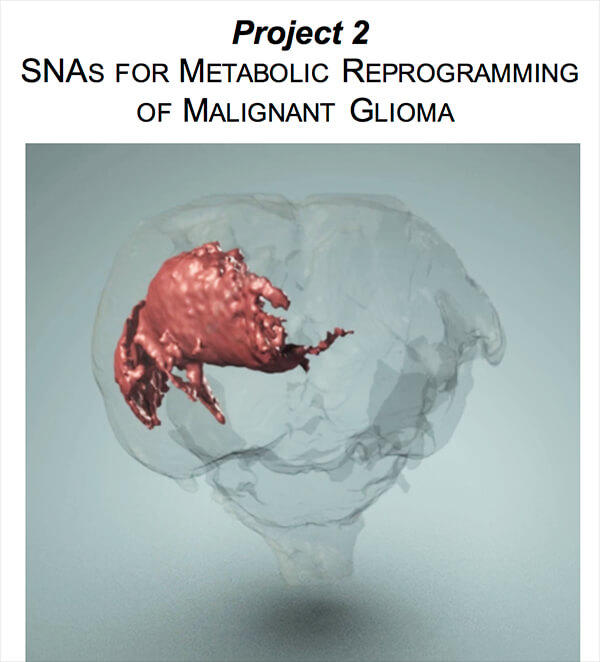 3D visualization of a brain with a highlighted red area, representing the targeted glioma.