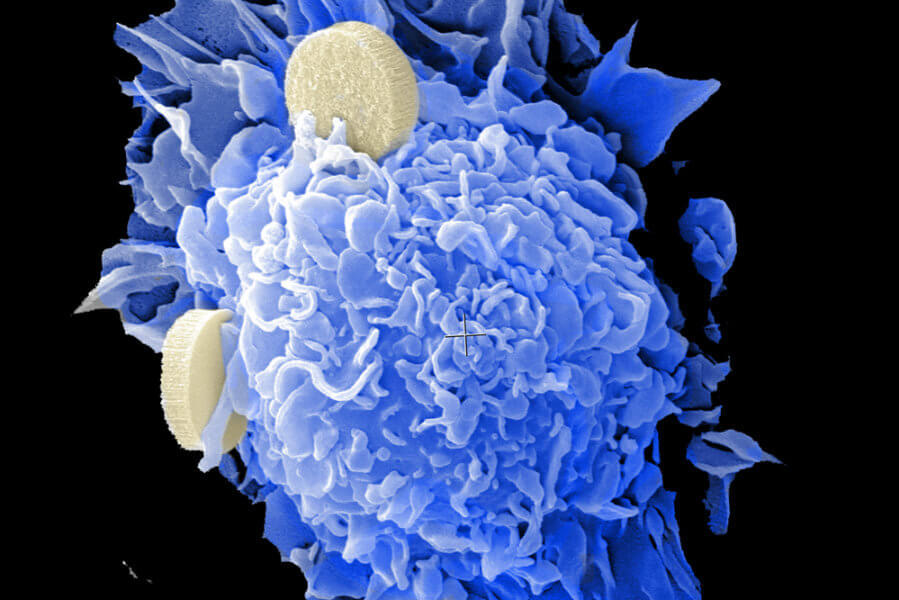 Dendritic cells with the nano-vaccines