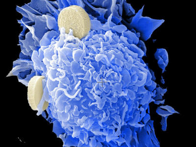 Dendritic cells with the nano-vaccines