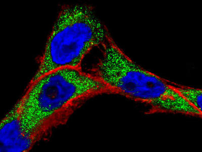 Microscopic view of cancer cells