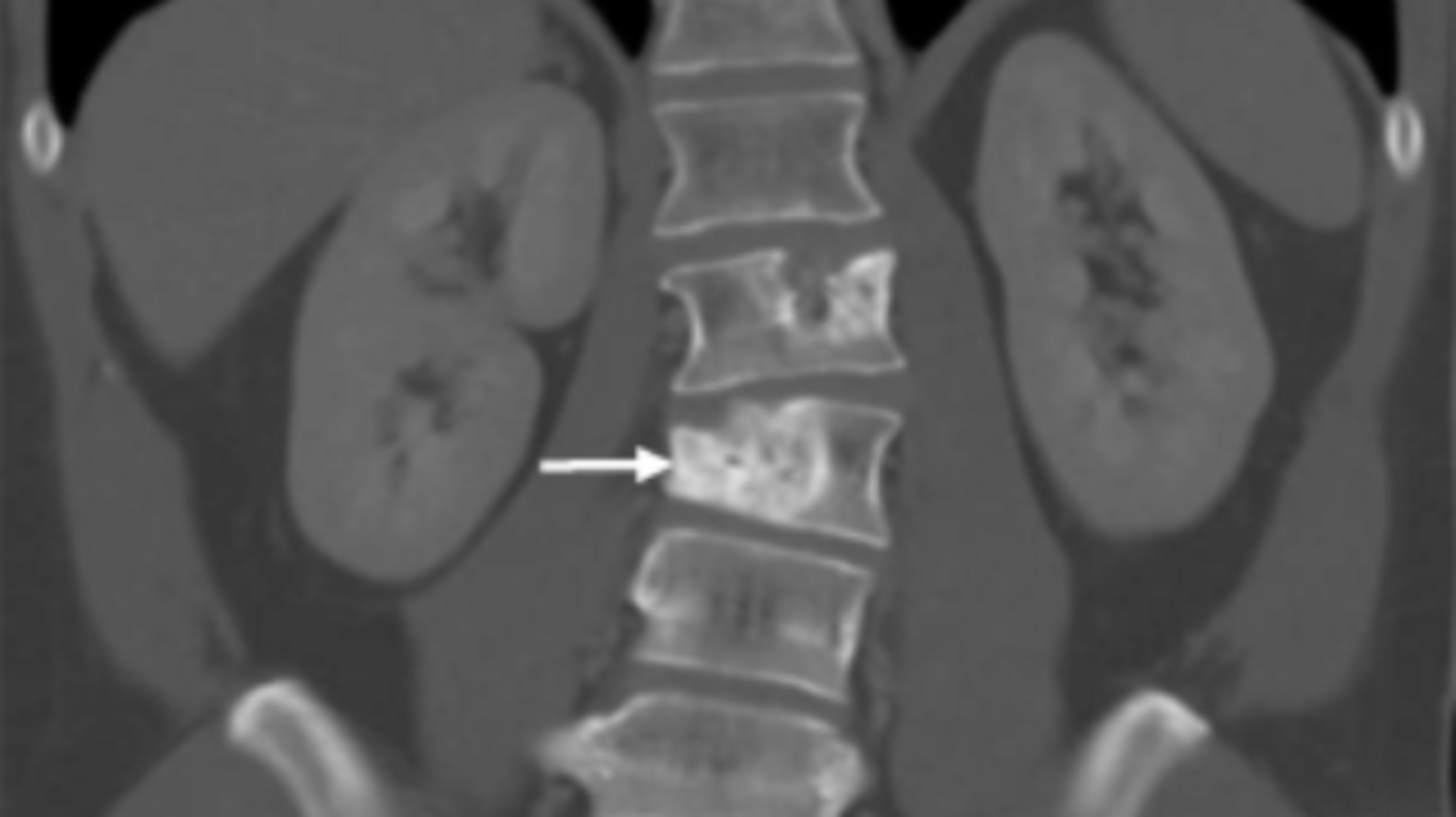 A CT scan showing a metastatic tumor embedded in a spinal vertabrae.