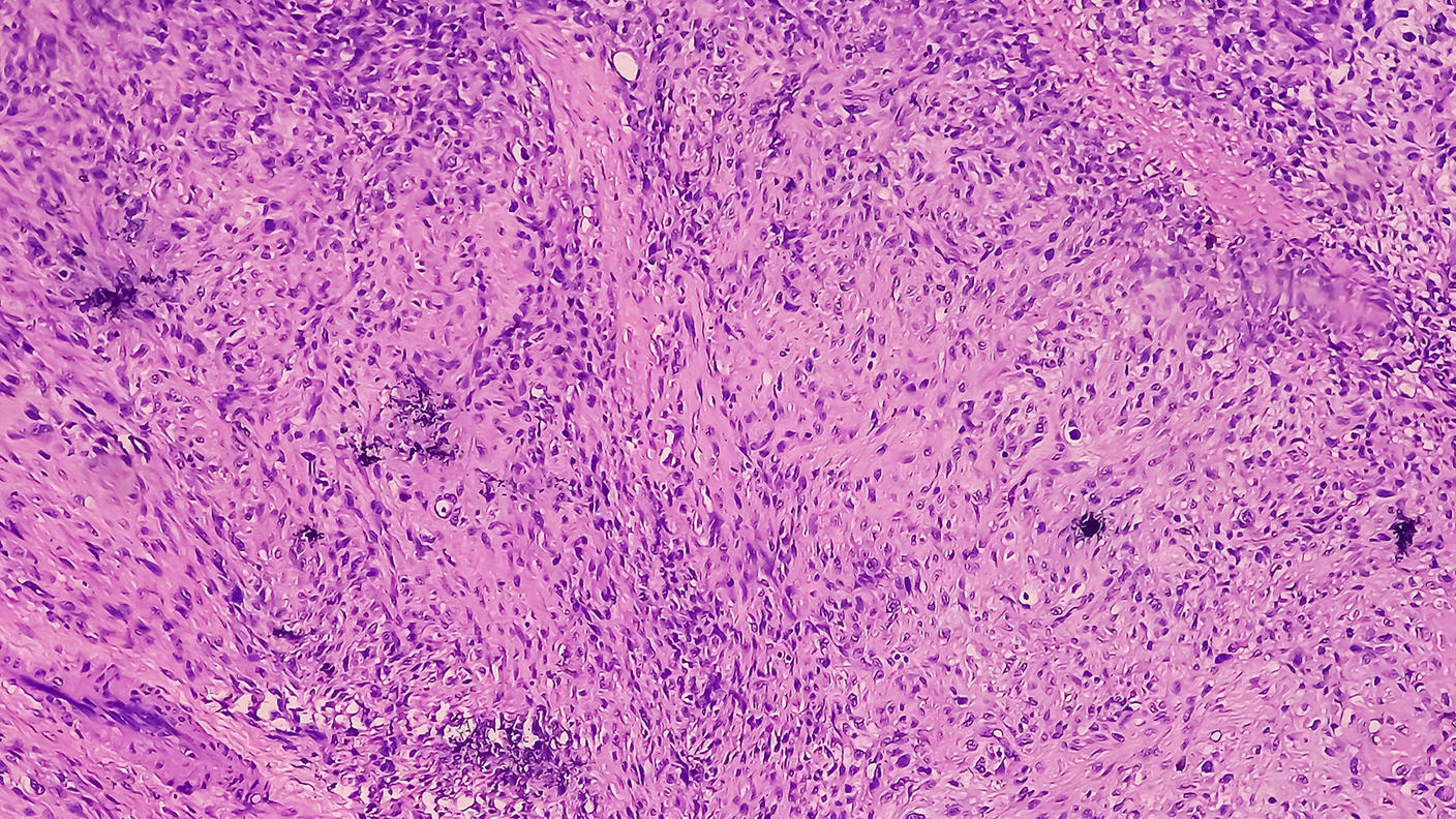 Microscopic image of atypical mesenchymal cells.