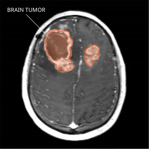 MRI of gliosarcoma tumors in the brain.