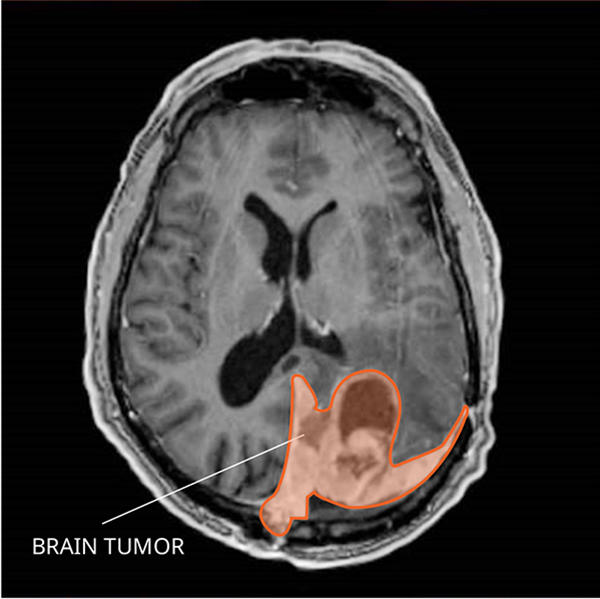 MRI of a meningioma in the brain.