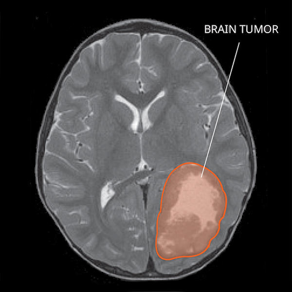 MRI of a primitive neuro-ectodermal tumor (PNET) in the brain.
