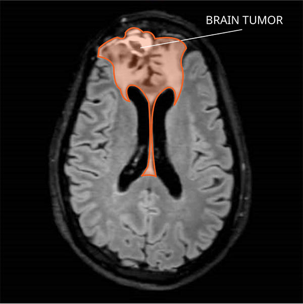 MRI of an oligodendroglioma in the brain