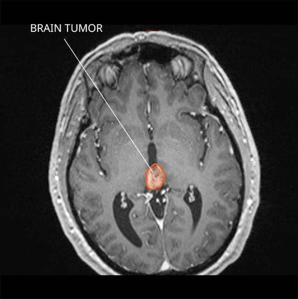 MRI of a pineal region tumor in the brain.