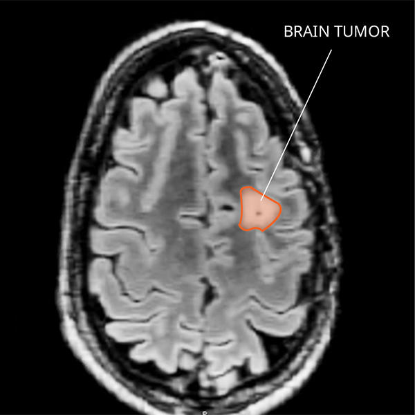 MRI of a pleomorphic xanthoastrocytoma (PXA) tumor in the brain