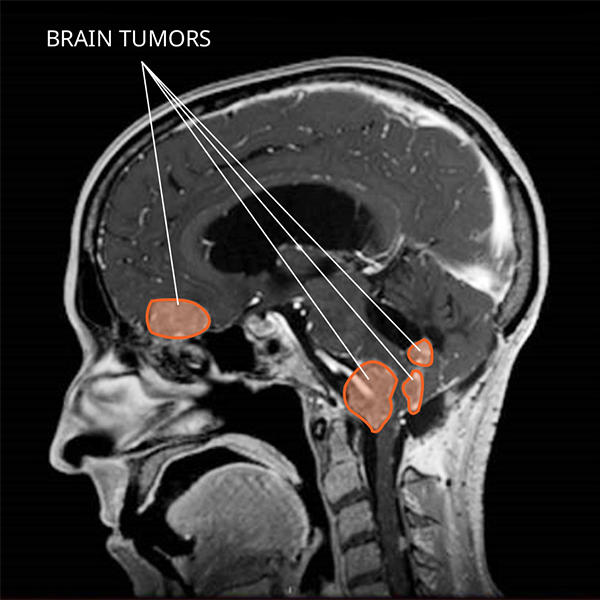 MRI scan of four choroid plexus tumors